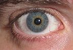 Eye Central Heterochromia.jpg